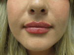 Lip Augmentation - Case 19210 - After