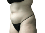 Coolsculpting® - Case 19218 - Before