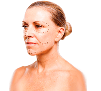 Middle aged woman with plastic surgery marks on her face